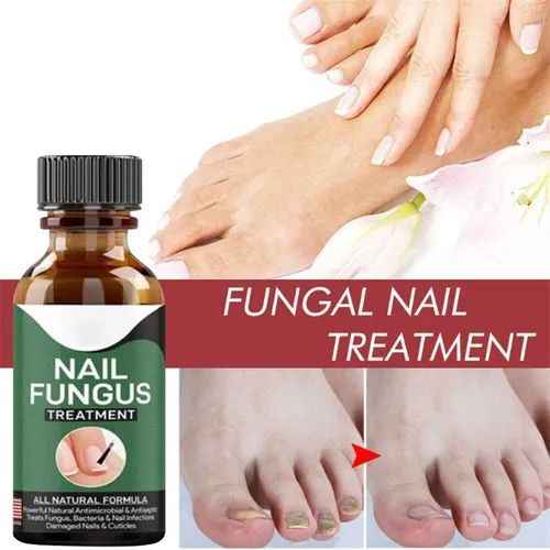 Fast Nail Fungal Treatment Gel – Nail Repair & Fungal Removal Serum - MustBuy.pk