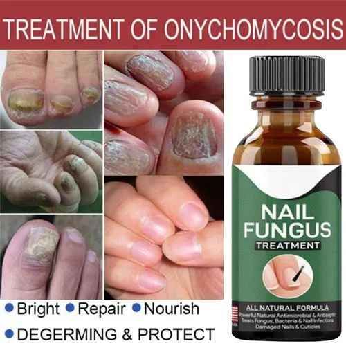 Fast Nail Fungal Treatment Gel - Nail Repair & Fungal Removal Serum - Image 2